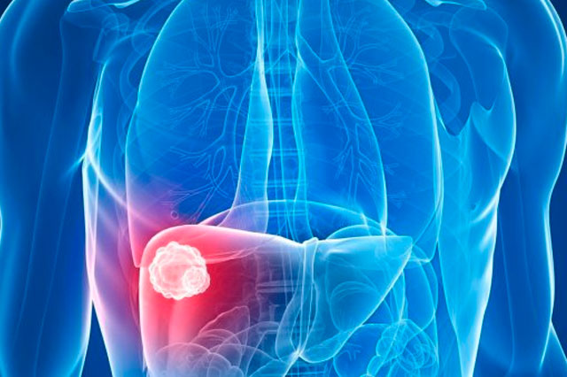 Dr Paulo Ramalho - Carcinoma Hepatocelular