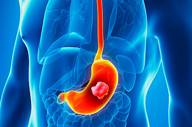 Dr Paulo Ramalho - Câncer de estômago