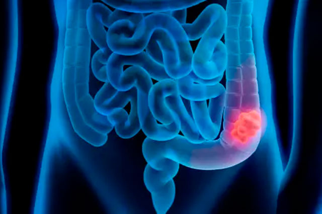 Dr Paulo Ramalho - Câncer colorretal